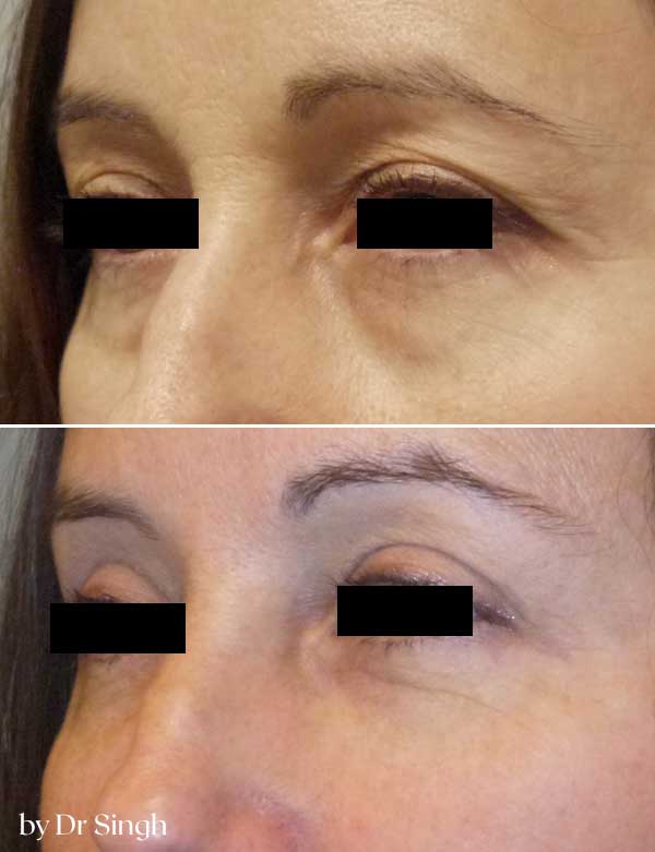 before after blepharoplasty nyc